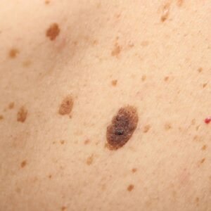 Queratosis seborreica