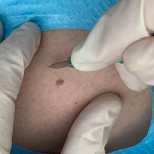 Biopsia por huso/ retiro de nevo