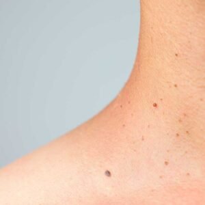 Rasurado fibromas blandos