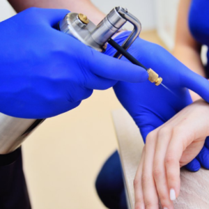 Crioterapia (Nitrógeno líquido)